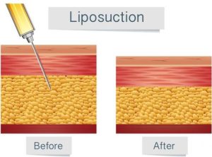 چگونگی عمل لیپوساکشن